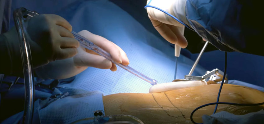 Minimally Invasive Cardiac Surgery (MICS)